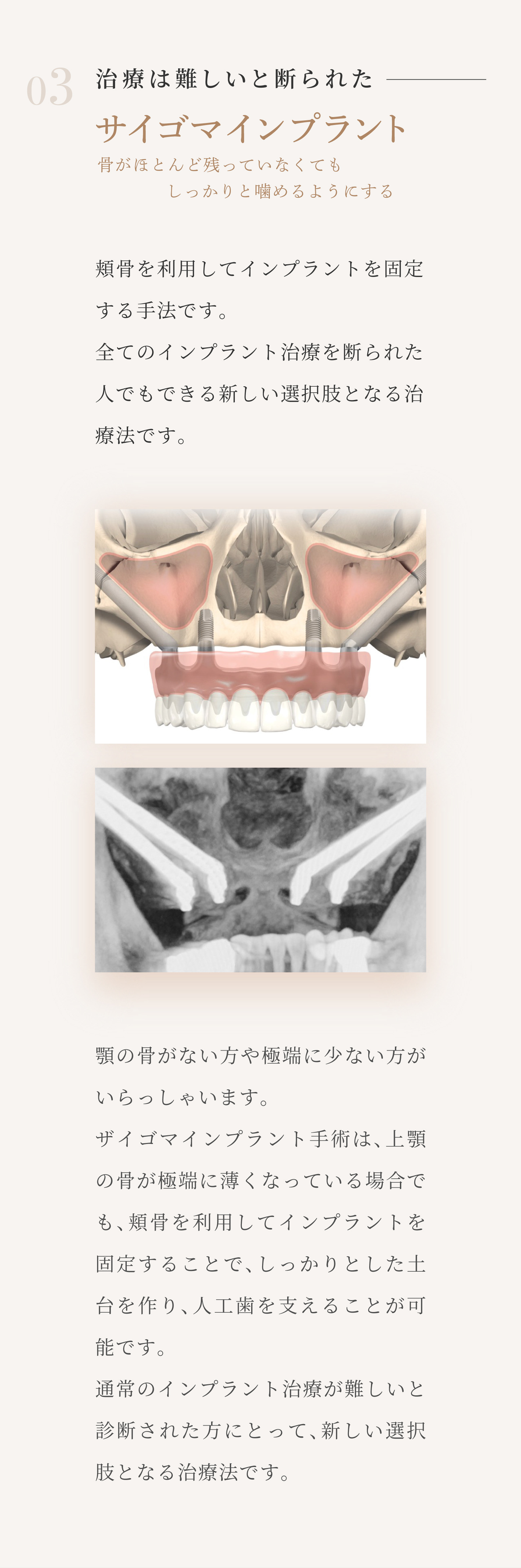 03 治療は難しいと断られた サイゴマインプラント 骨がほとんど残っていなくてもしっかりと噛めるようにする 頬骨を利用してインプラントを固定する手法です。全てのインプラント治療を断られた人でもできる新しい選択肢となる治療法です。顎の骨がない方や極端に少ない方がいらっしゃいます。ザイゴマインプラント手術は、上顎の骨が極端に薄くなっている場合でも、頬骨を利用してインプラントを固定することで、しっかりとした土台を作り、人工歯を支えることが可能です。通常のインプラント治療が難しいと診断された方にとって、新しい選択肢となる治療法です。